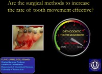 Are the Surgical Methods to Increase the Rate of Tooth Movement Effective? icon