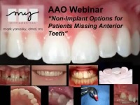 2010 AAO Webinar - Non-Implant Replacement of Missing Anterior Teeth