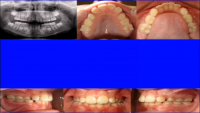 Point/Counterpoint: Extraction in the Mixed Dentition -- A Reasonable Option for Selected Patients? icon