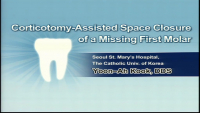 Corticotomy-assisted Accelerated Space Closure of a Missing Molar by Utilizing the Third Molar