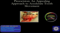 Piezocision: An Appealing Approach to Accelerate Tooth Movement