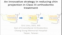 An Innovative Strategy in Reducing Chin Projection in Class III Orthodontic Treatment 