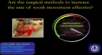Are the Surgical Methods to Increase the Rate of Tooth Movement Effective? icon