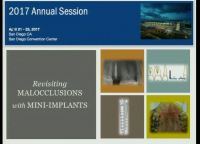 Revisiting Malocclusions with Mini-implants