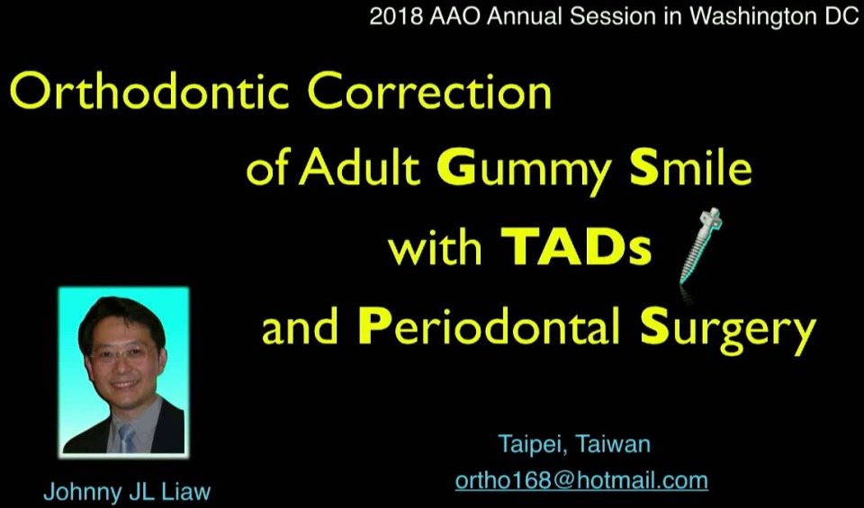 Orthodontic Correction of Adult Gummy Smile with TADs and Periodontal
