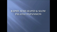 Rapid, Semi-rapid and Slow Palatal Expansion