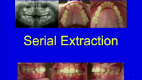 Serial Extraction: Beyond the Basics