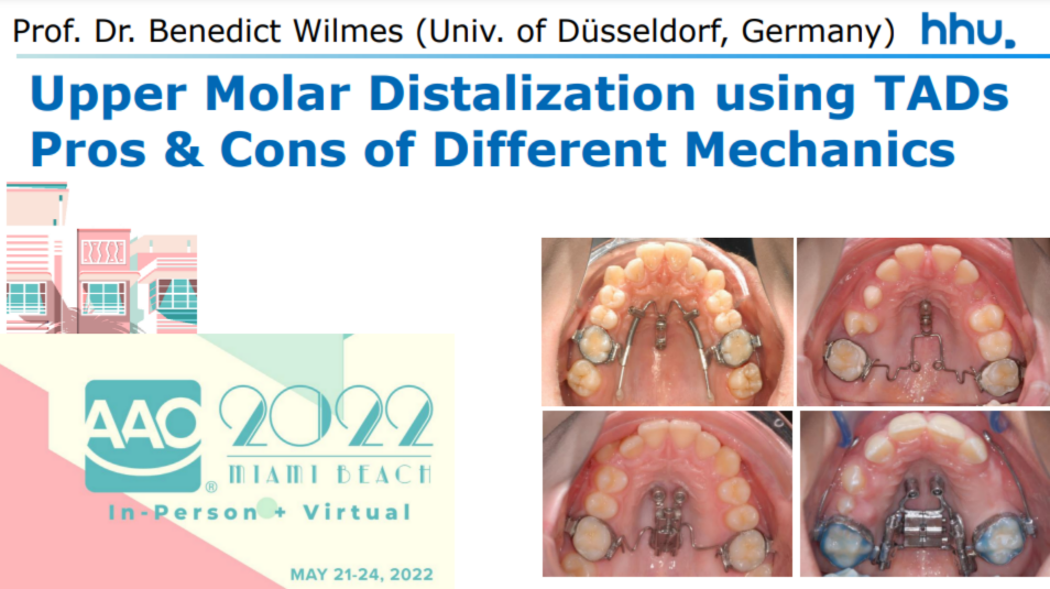 Upper Molar Distalization using TADs: Pros & Cons of Different Mechanics