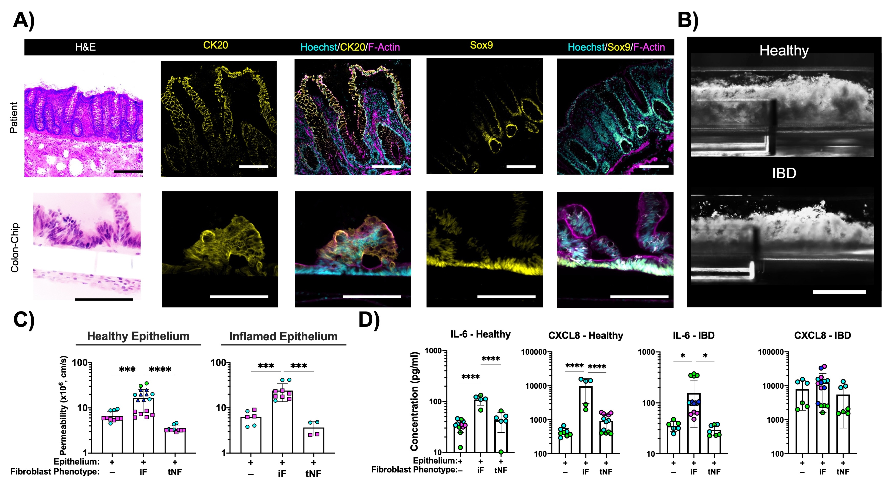 MODELING INFLAMMATORY BOWEL DISEASE PROGRESSION IN HUMAN ORGANCHIPS