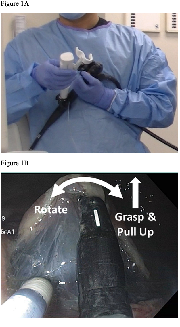 INITIAL MULTICENTER EXPERIENCE USING A NOVEL ARTICULATING THROUGHTHE