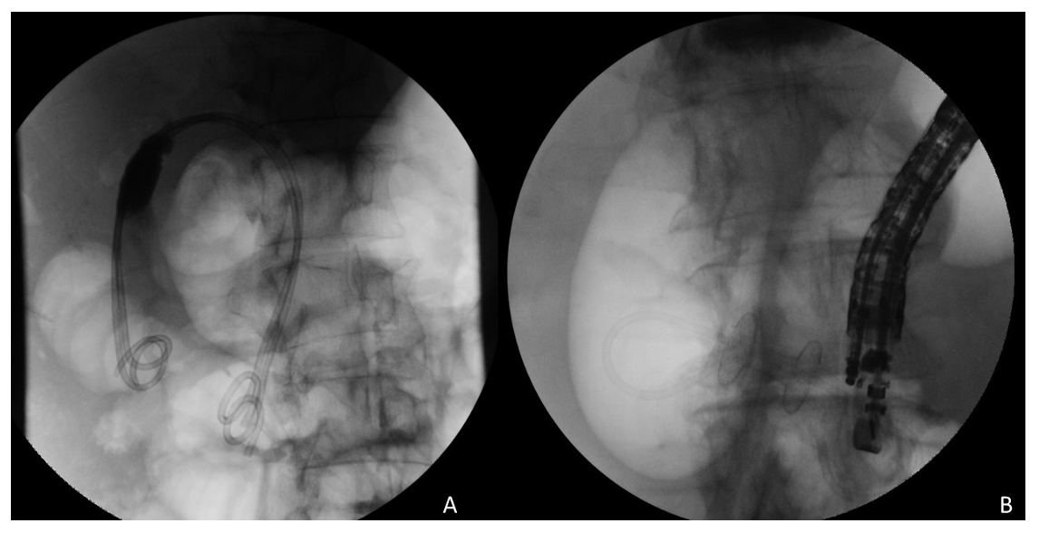 BILIARY ENDOSCOPIC DRAINAGE OF SEPTIC ICU PATIENTS DEEMED EMERGENT